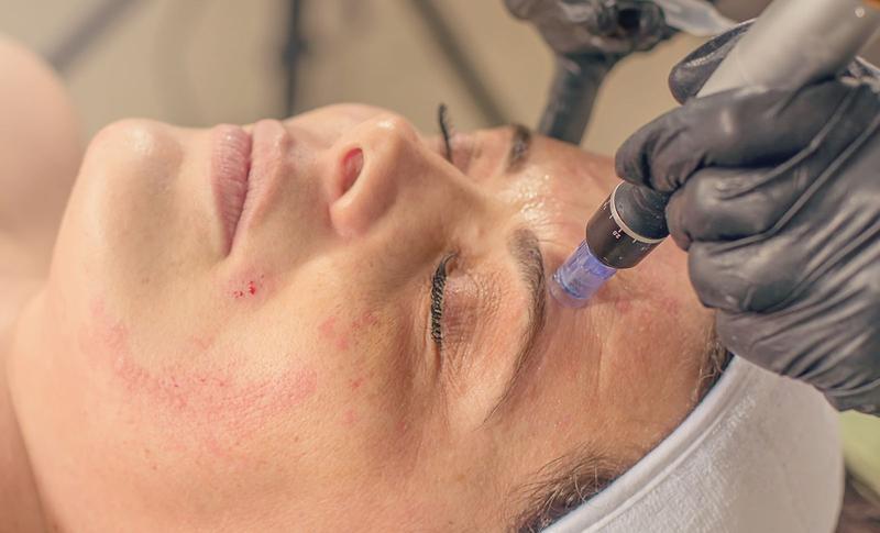 Dermapen und die Collagen-Induktions-Therapie